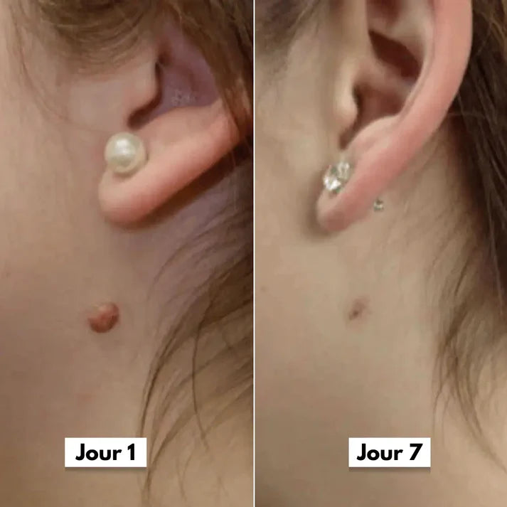 SEFUDUN™ – La solution pratique pour prendre soin des acrochordons à domicile