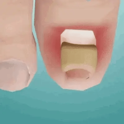 Patchs contre les mycoses d'Ongles – Révélez la beauté de vos ongles