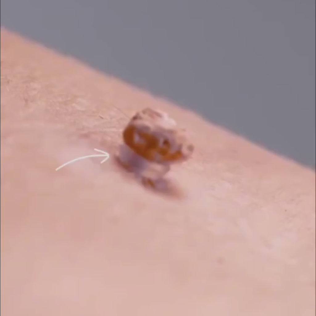 SEFUDUN™ – La solution pratique pour prendre soin des acrochordons à domicile